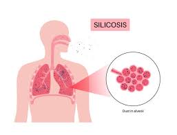 Tackling Silica Dust Exposure: How AIRsteril Supports Safer Air in High-Risk Workplaces